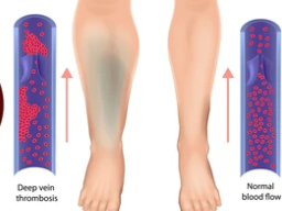 Emotionale Heilung Blutfluss und Venostase