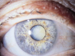 Emotionale Heilung Grauer Star