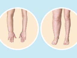 Emotionale Heilung Lymphödem