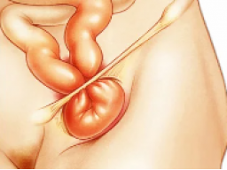 Emotionale Heilung Hernien (Leistenbruch)