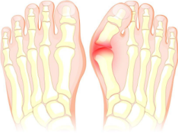Emotionale Heilung Valgus (Fehlstellung des Fußes)